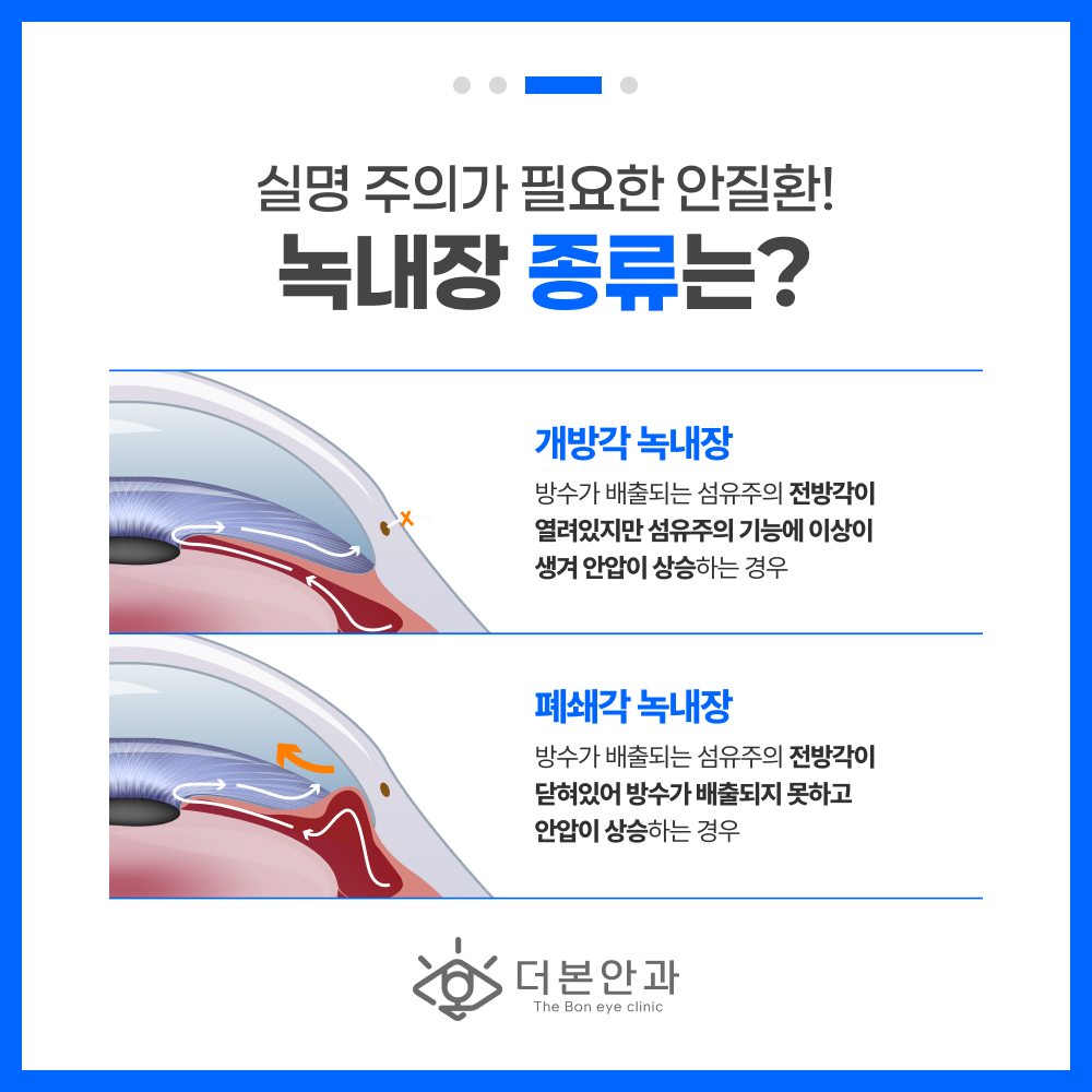 분당녹내장증상 시야 협착 설명 이미지